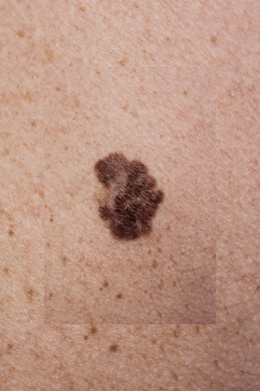 Prevención del melanoma