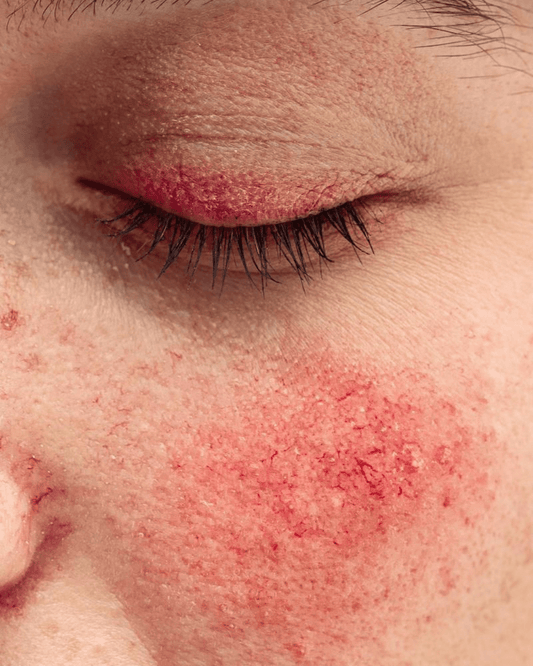 Rosácea, guía experta para calmar la rojez y recuperar tu piel